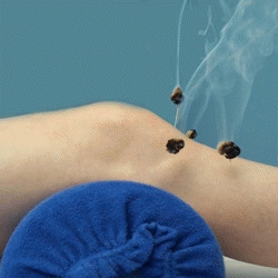 La moxibustion